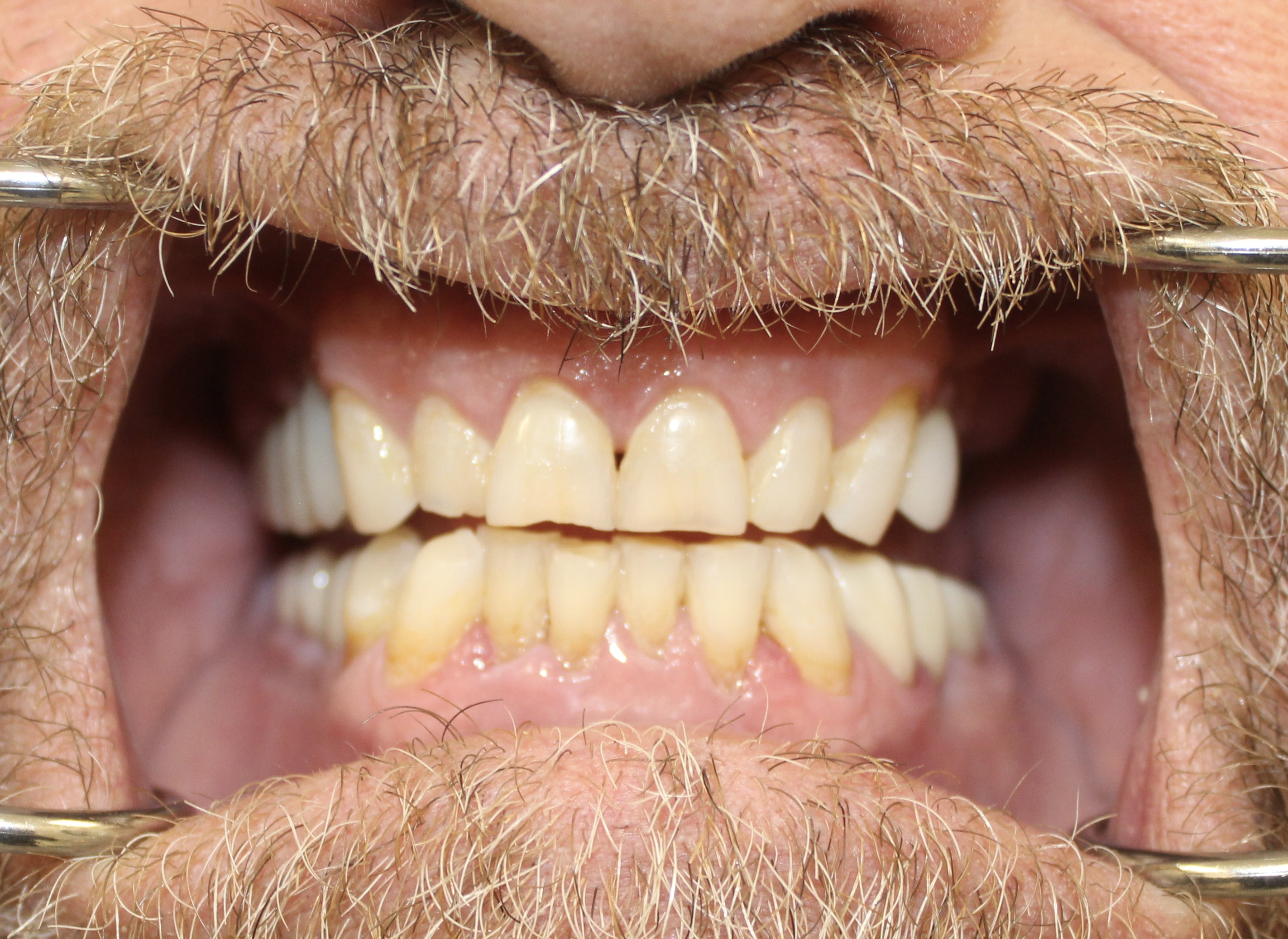 Full-arch maxillary rehabilitation — Megatec Dental Lab restoration photograph 1