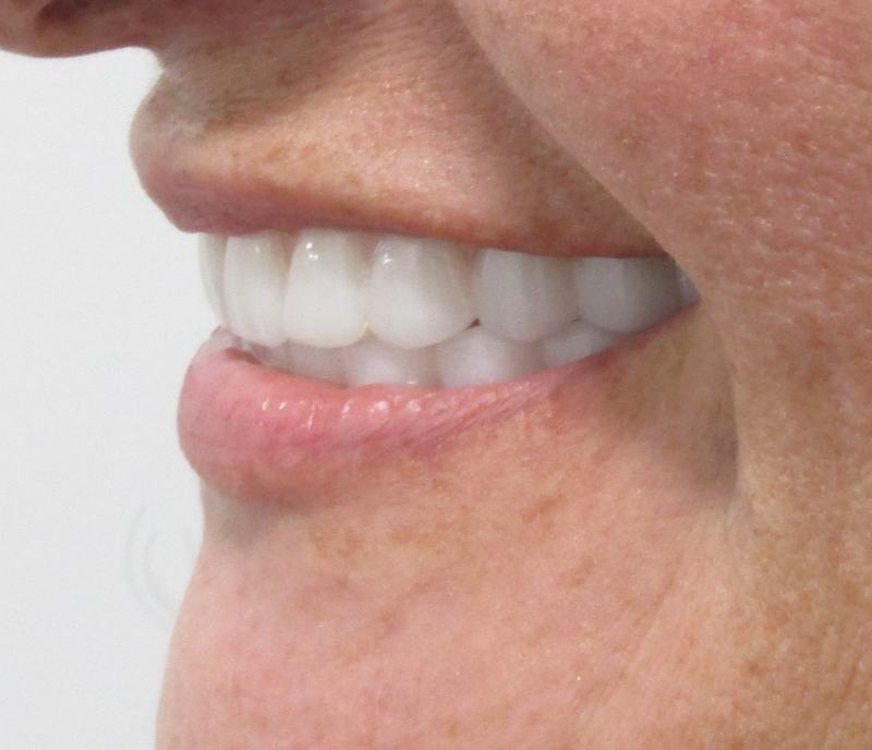 Megatec Dental Lab All-on-X restoration — Case 2