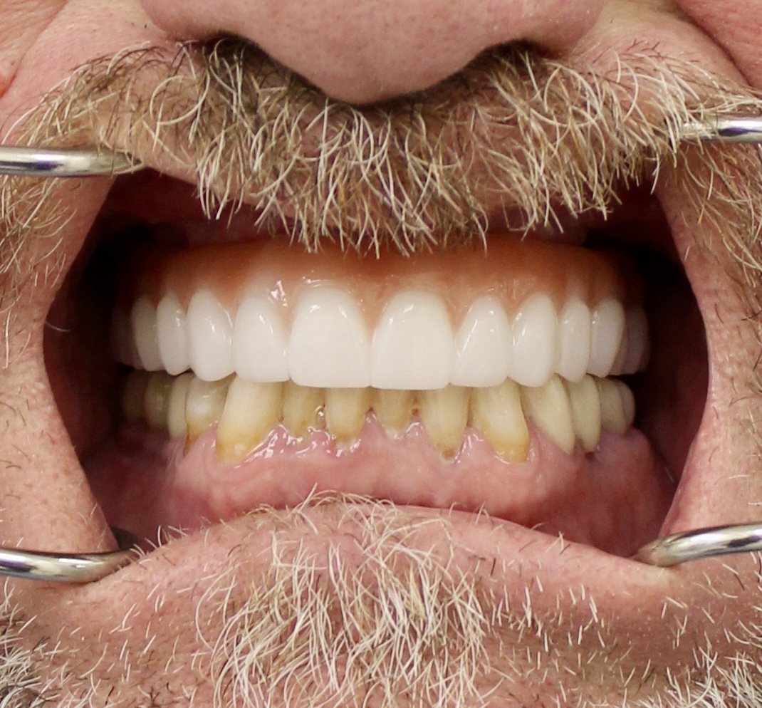 Full-arch maxillary rehabilitation — Megatec Dental Lab restoration photograph 3