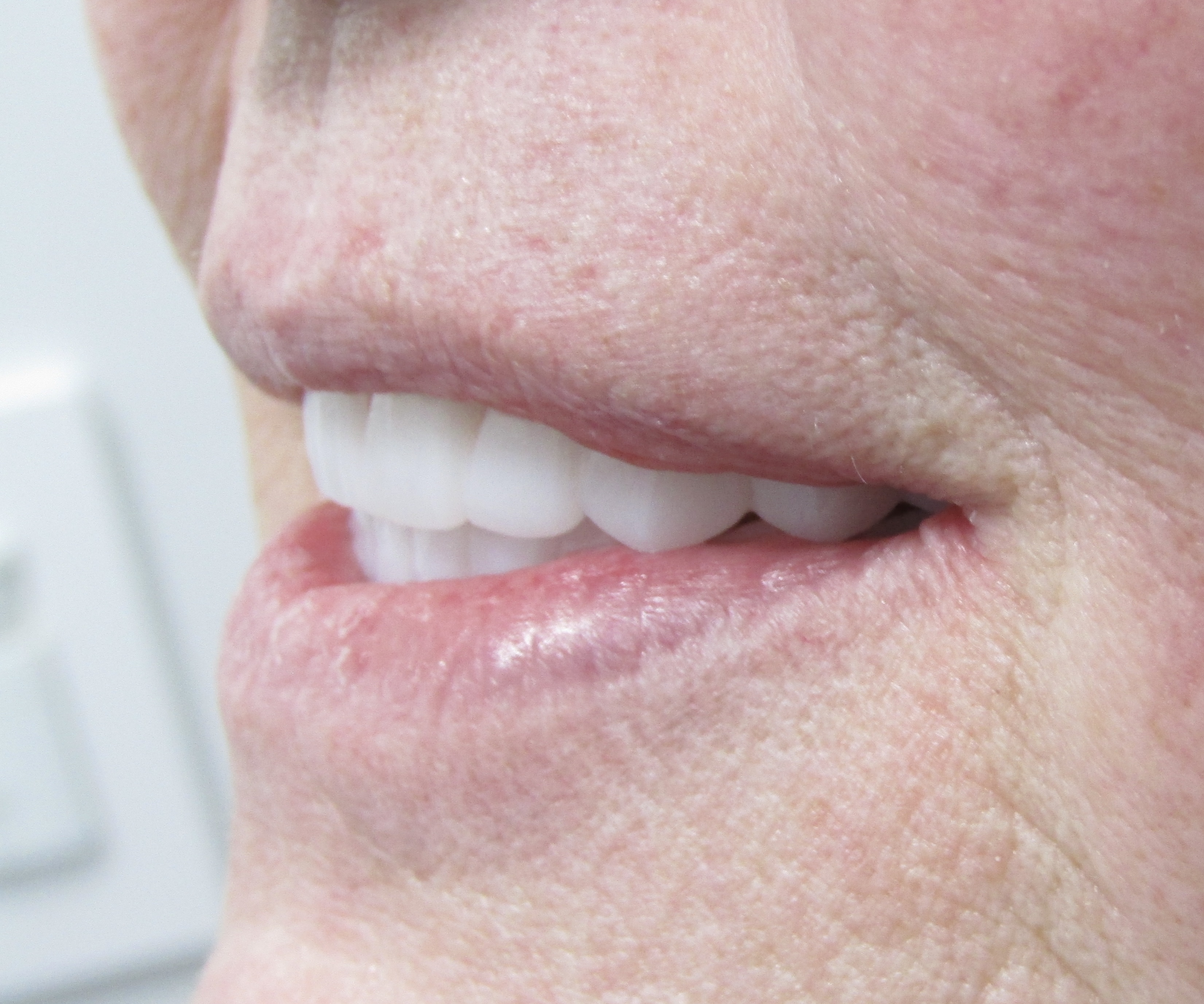 Guided surgery to final prosthesis — Megatec Dental Lab restoration photograph 4
