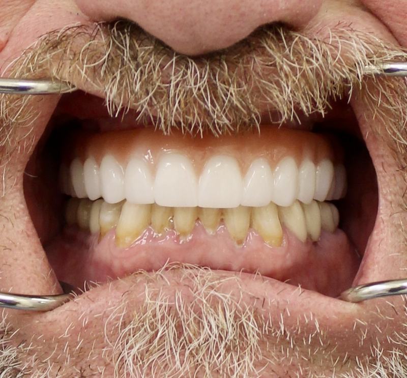 Megatec Dental Lab All-on-X restoration — Case 1