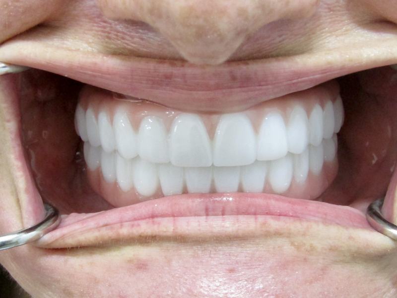 Megatec Dental Lab All-on-X restoration — Case 2