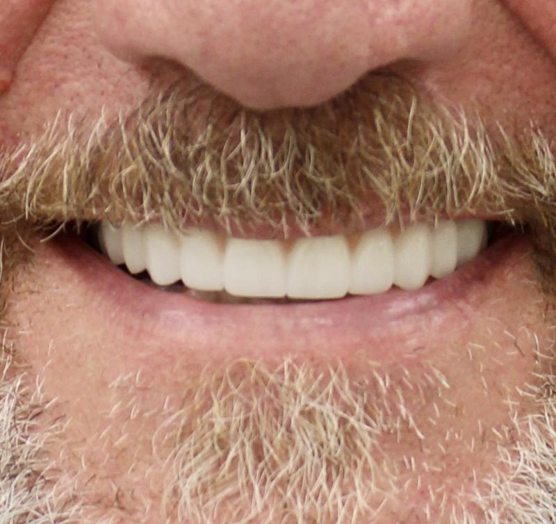 Megatec Dental Lab All-on-X restoration — Case 1