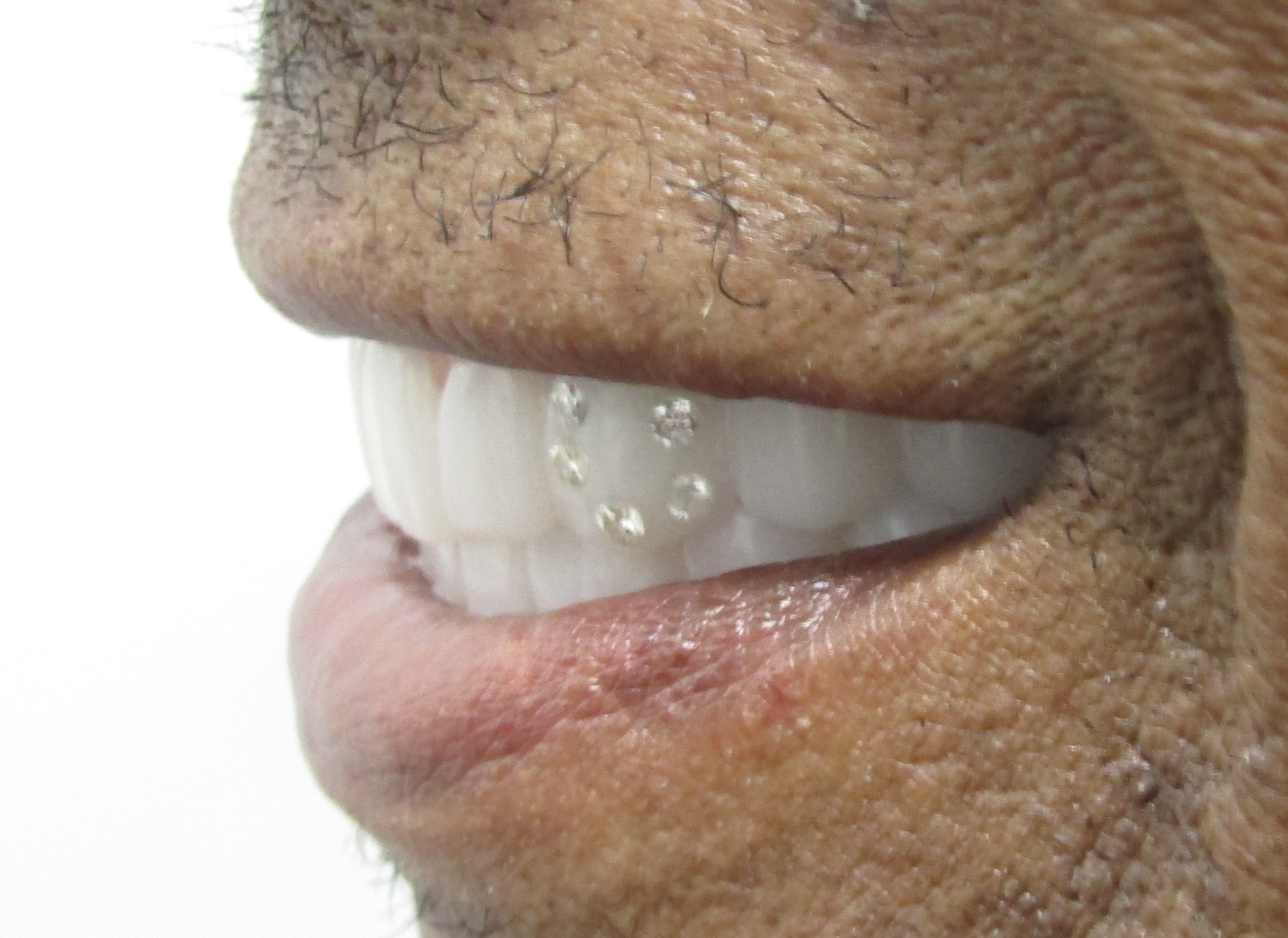 Complex implant rehabilitation — Megatec Dental Lab restoration photograph 4