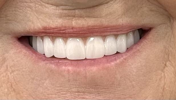 Megatec Dental Lab All-on-X restoration — Case 5