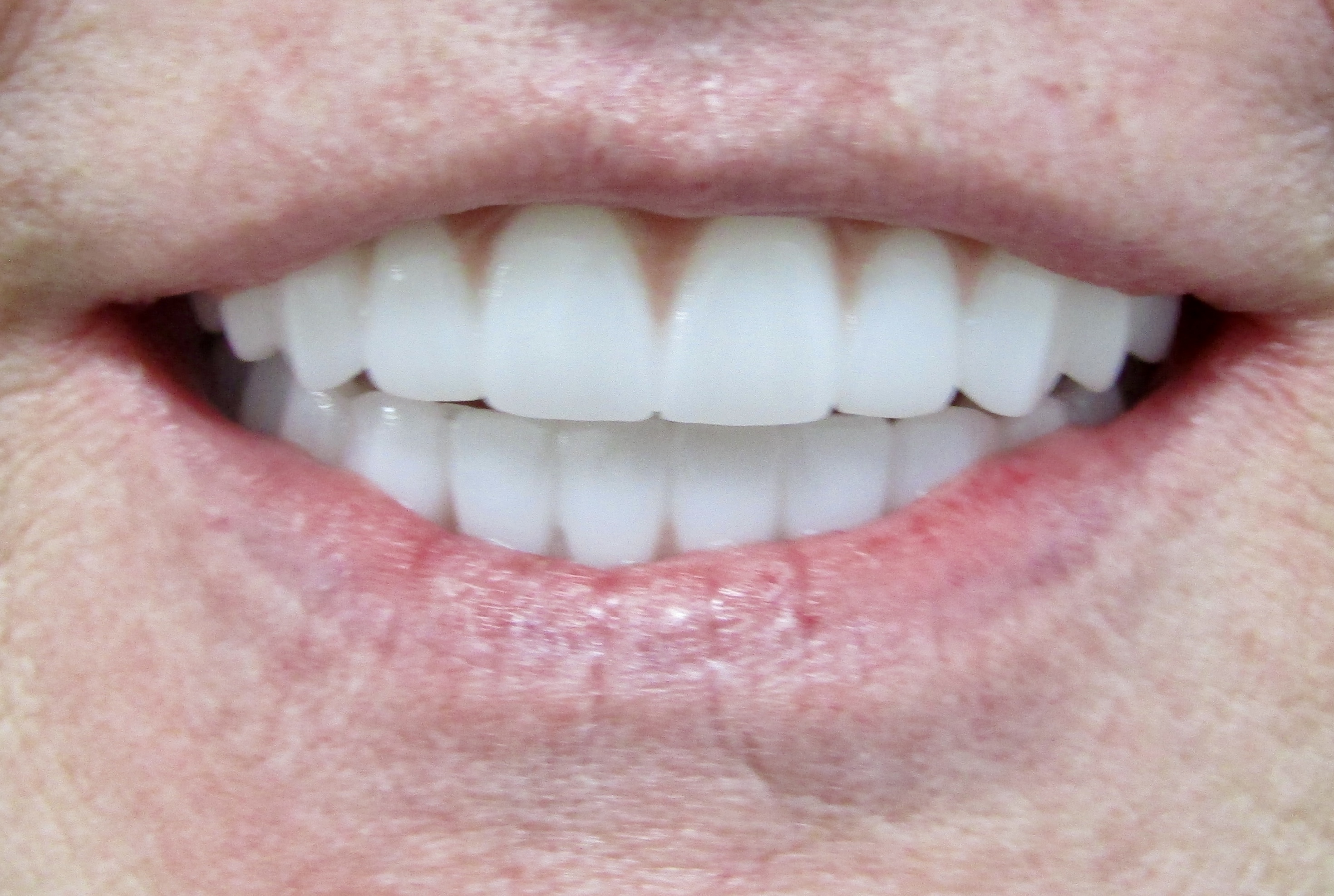 Guided surgery to final prosthesis — Megatec Dental Lab restoration photograph 2