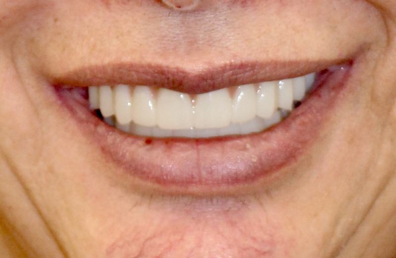 Megatec Dental Lab All-on-X restoration — Case 4