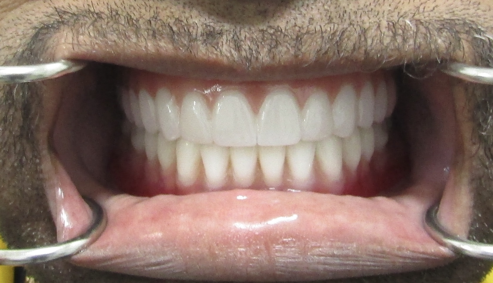Mandibular All-on-X — Megatec Dental Lab restoration photograph 1