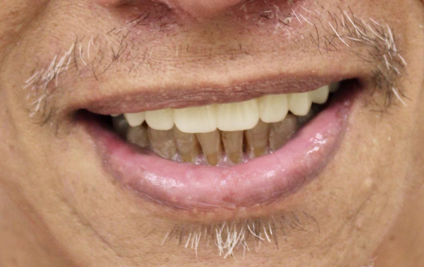 Immediate conversion to definitive — Megatec Dental Lab restoration photograph 3