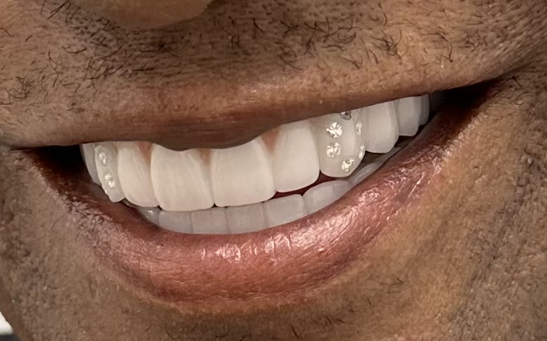 Complex implant rehabilitation — Megatec Dental Lab restoration photograph 3