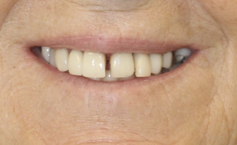 Megatec Dental Lab All-on-X restoration — Case 5
