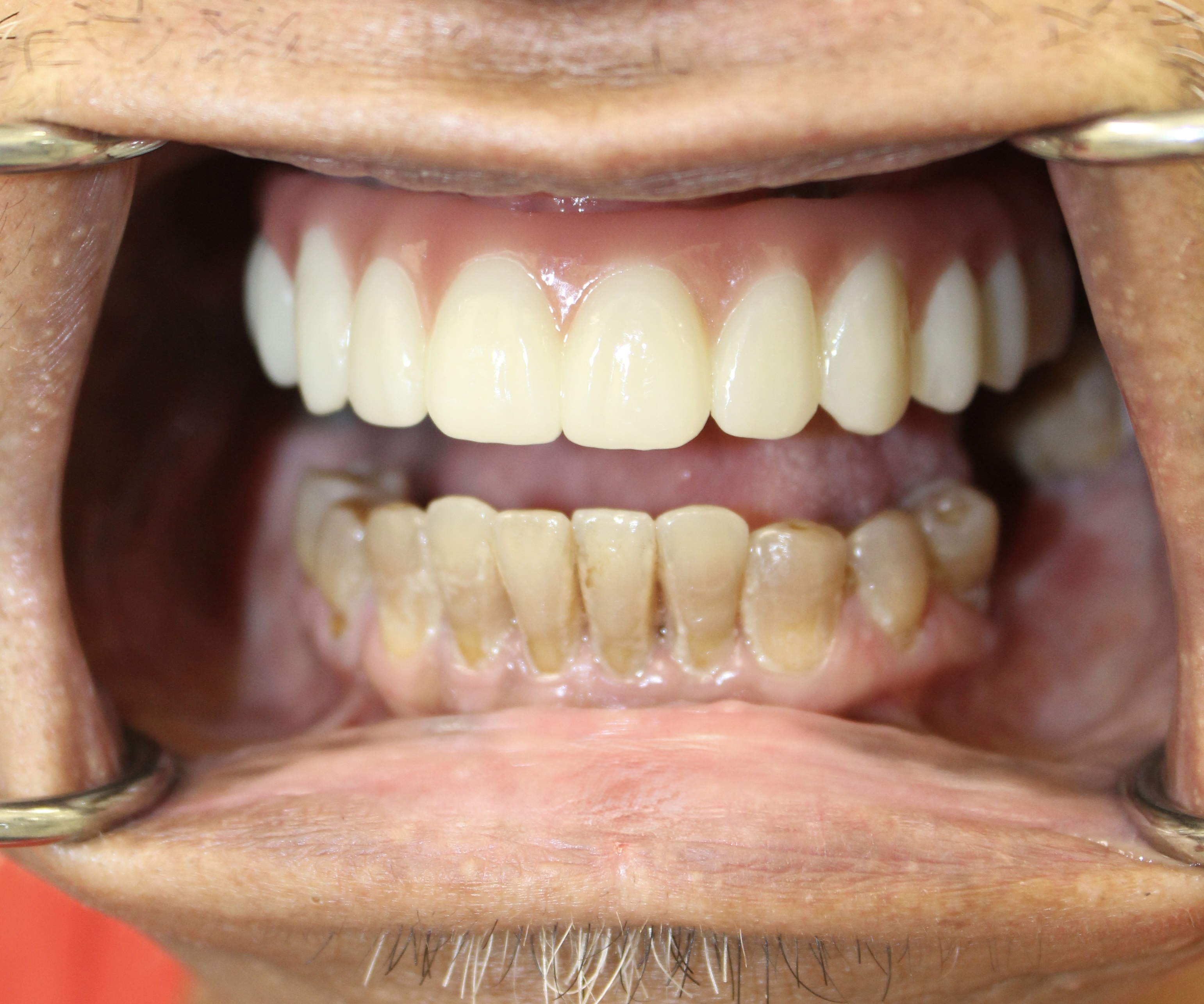 Immediate conversion to definitive — Megatec Dental Lab restoration photograph 2