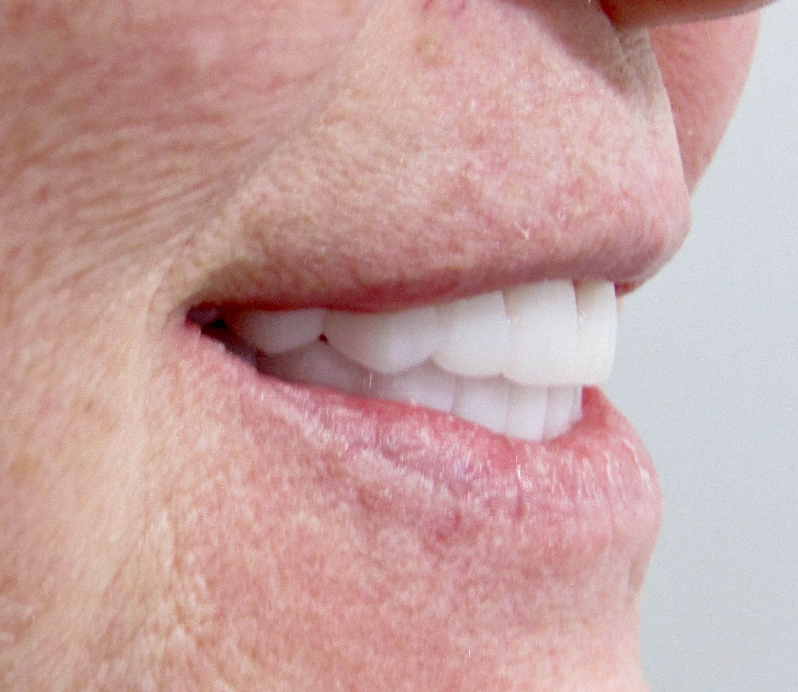 Guided surgery to final prosthesis — Megatec Dental Lab restoration photograph 3