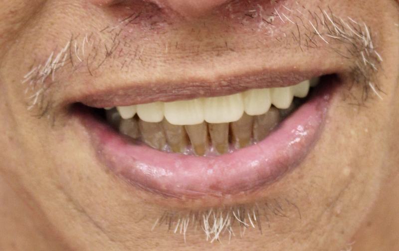 Megatec Dental Lab All-on-X restoration — Case 3