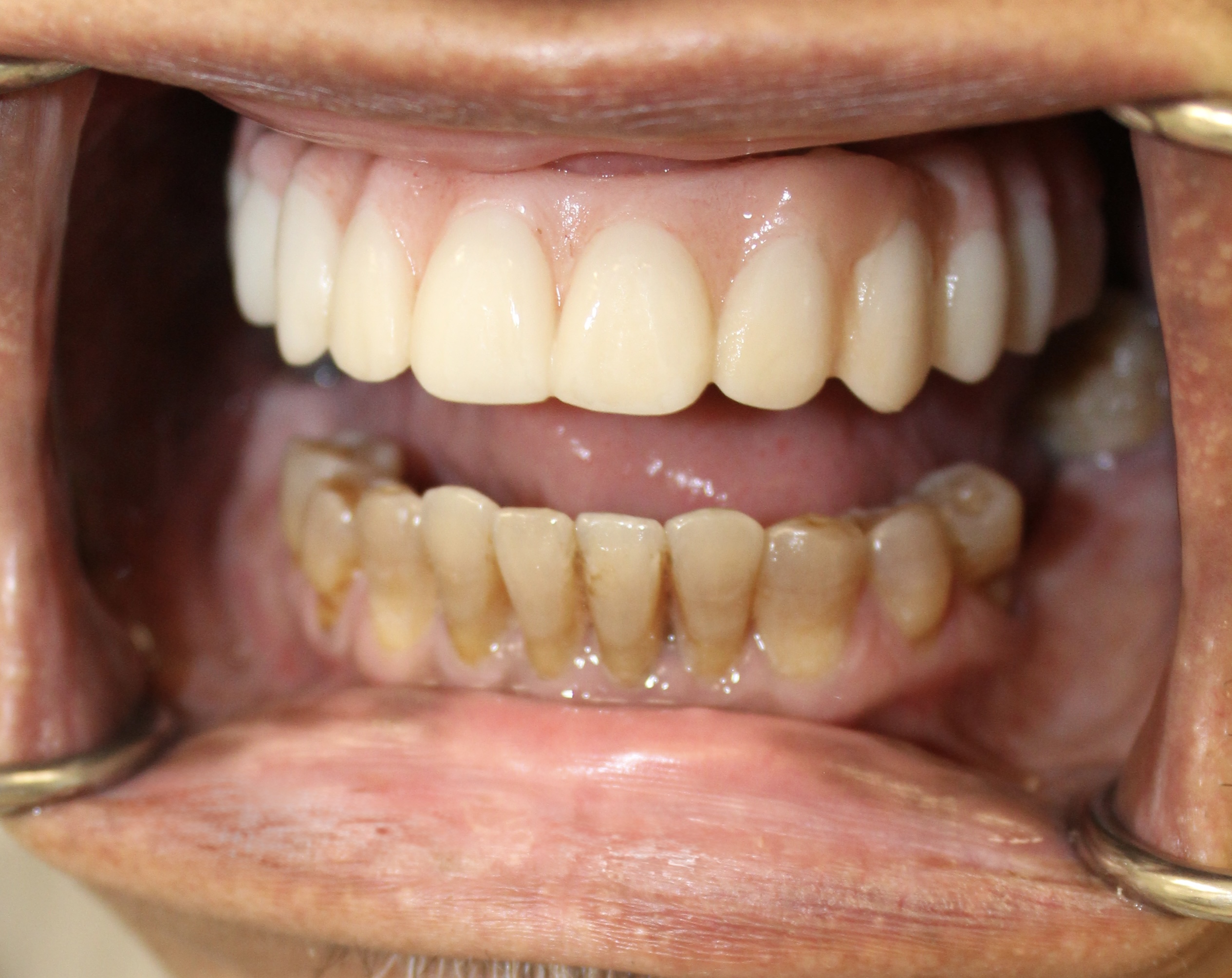 Immediate conversion to definitive — Megatec Dental Lab restoration photograph 1