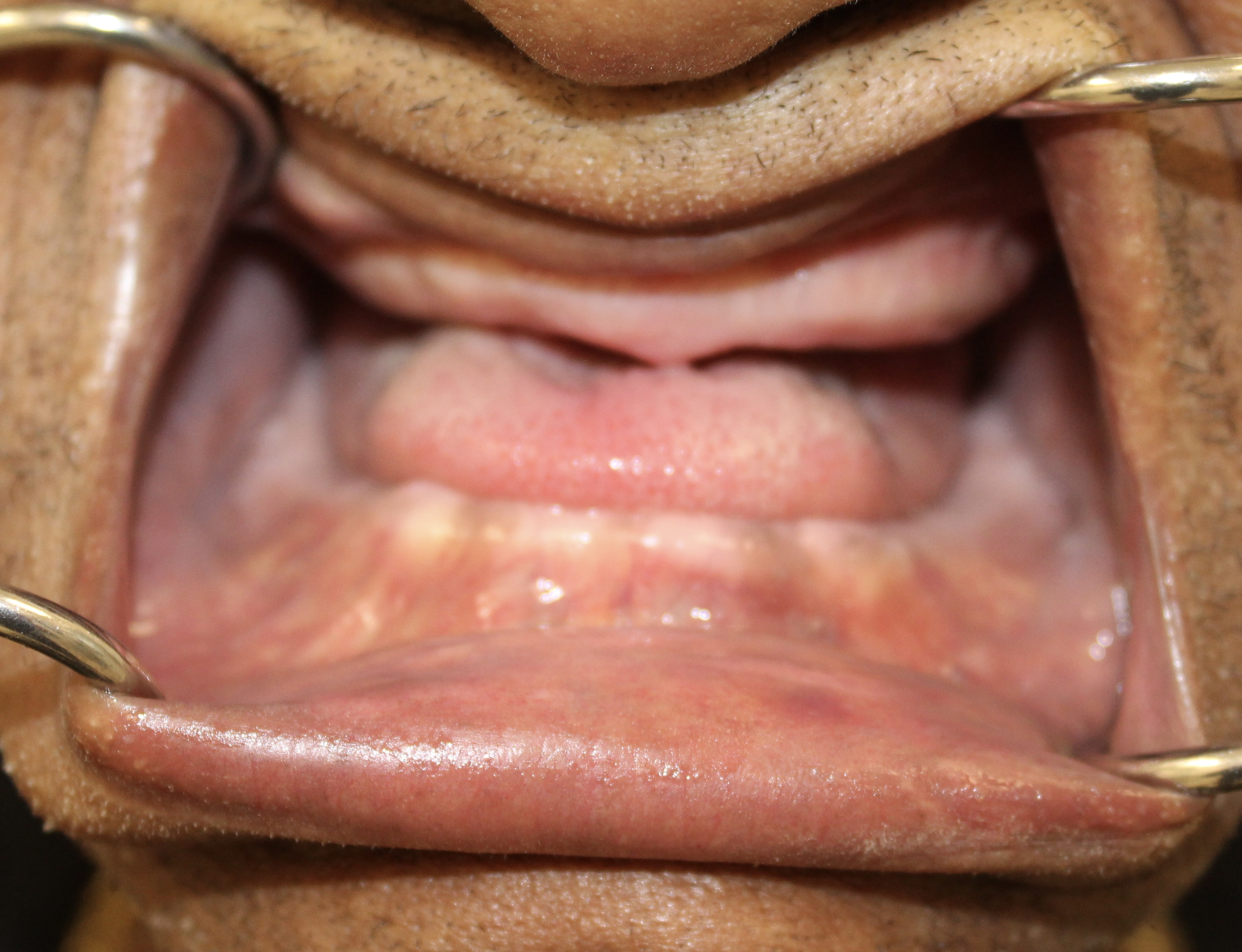 Complex implant rehabilitation — Megatec Dental Lab restoration photograph 1
