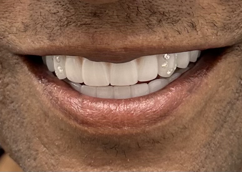 Complex implant rehabilitation — Megatec Dental Lab restoration photograph 2