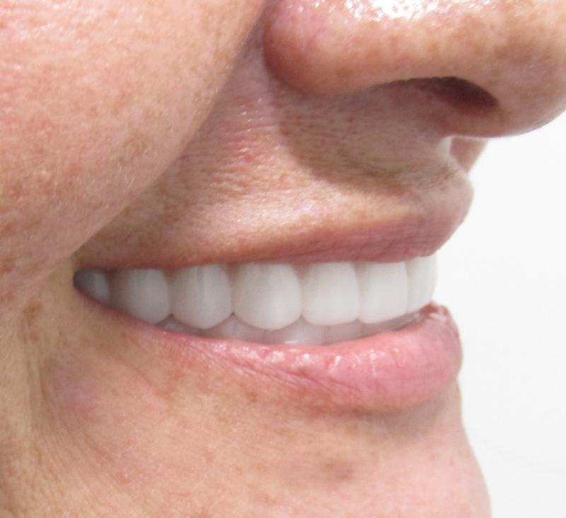 Megatec Dental Lab All-on-X restoration — Case 2