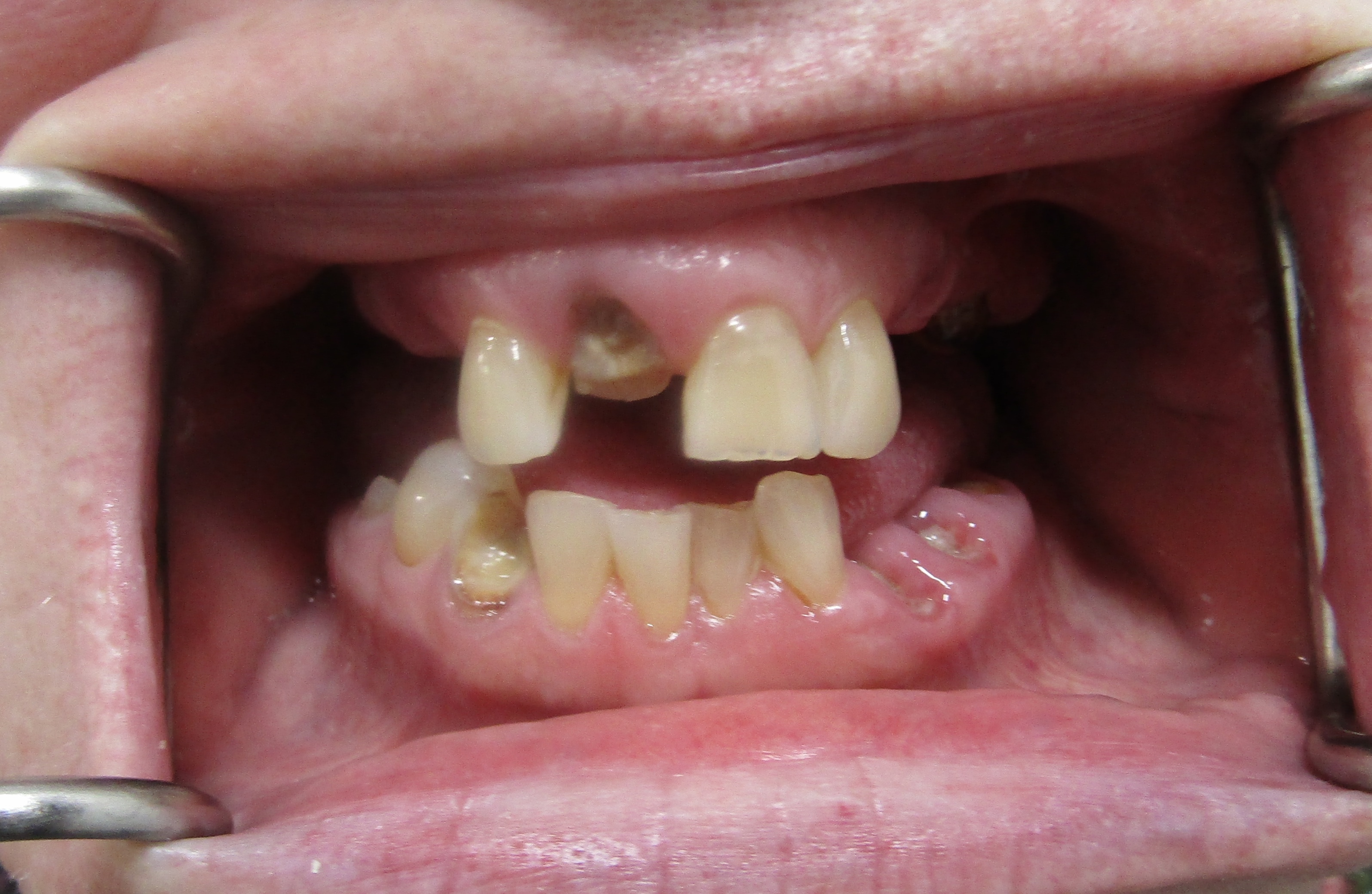 Guided surgery to final prosthesis — Megatec Dental Lab restoration photograph 1