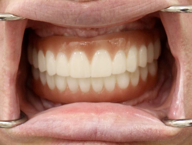 Megatec Dental Lab All-on-X restoration — Case 4