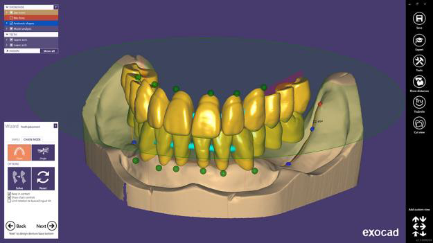 Digitally designed full-arch restoration