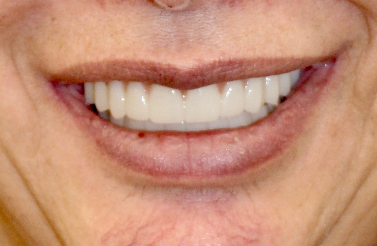 Anterior esthetic full-arch — Megatec Dental Lab restoration photograph 1