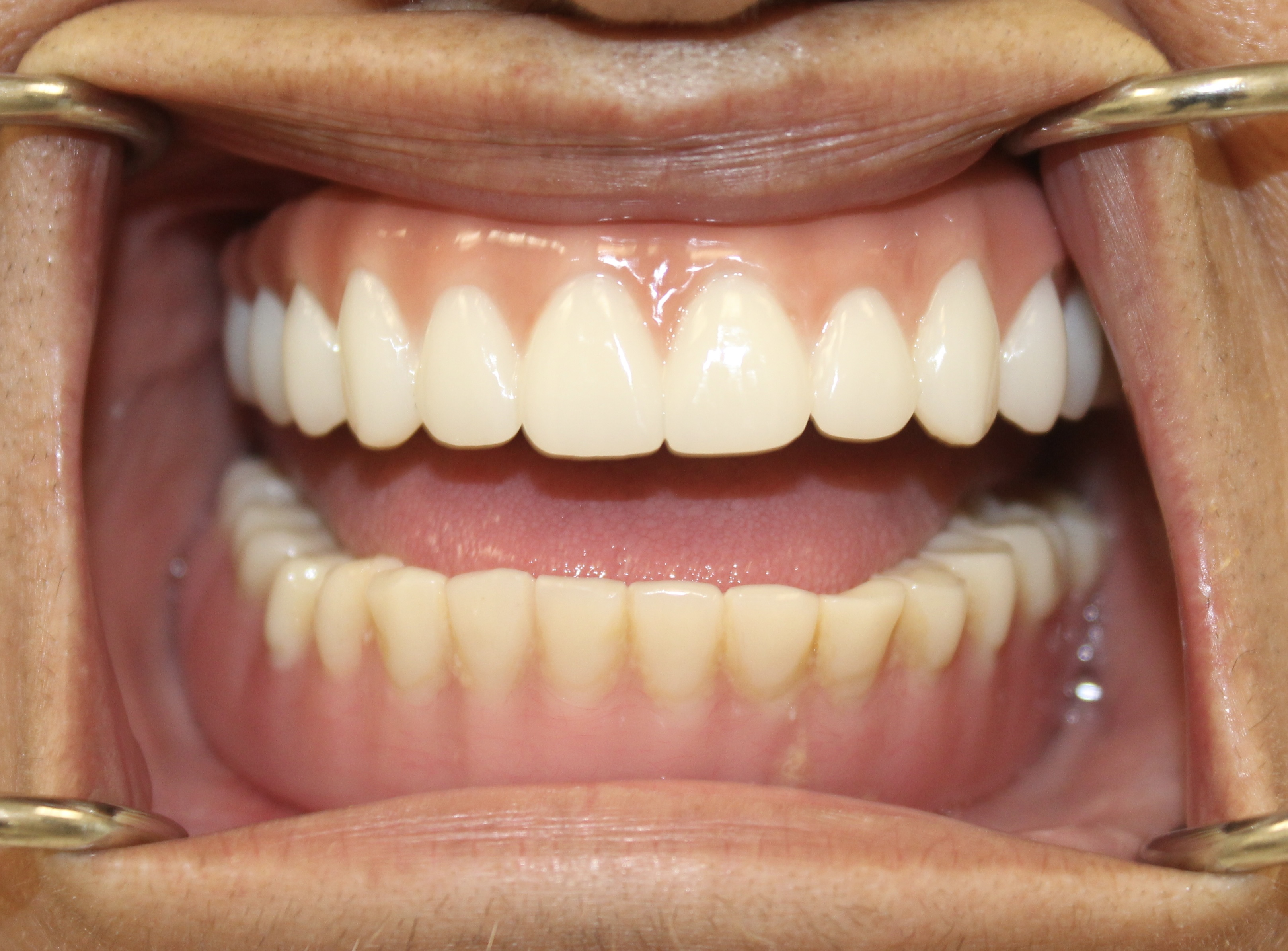 Digital workflow full-arch — Megatec Dental Lab restoration photograph 2