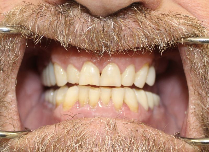 Megatec Dental Lab All-on-X restoration — Case 1