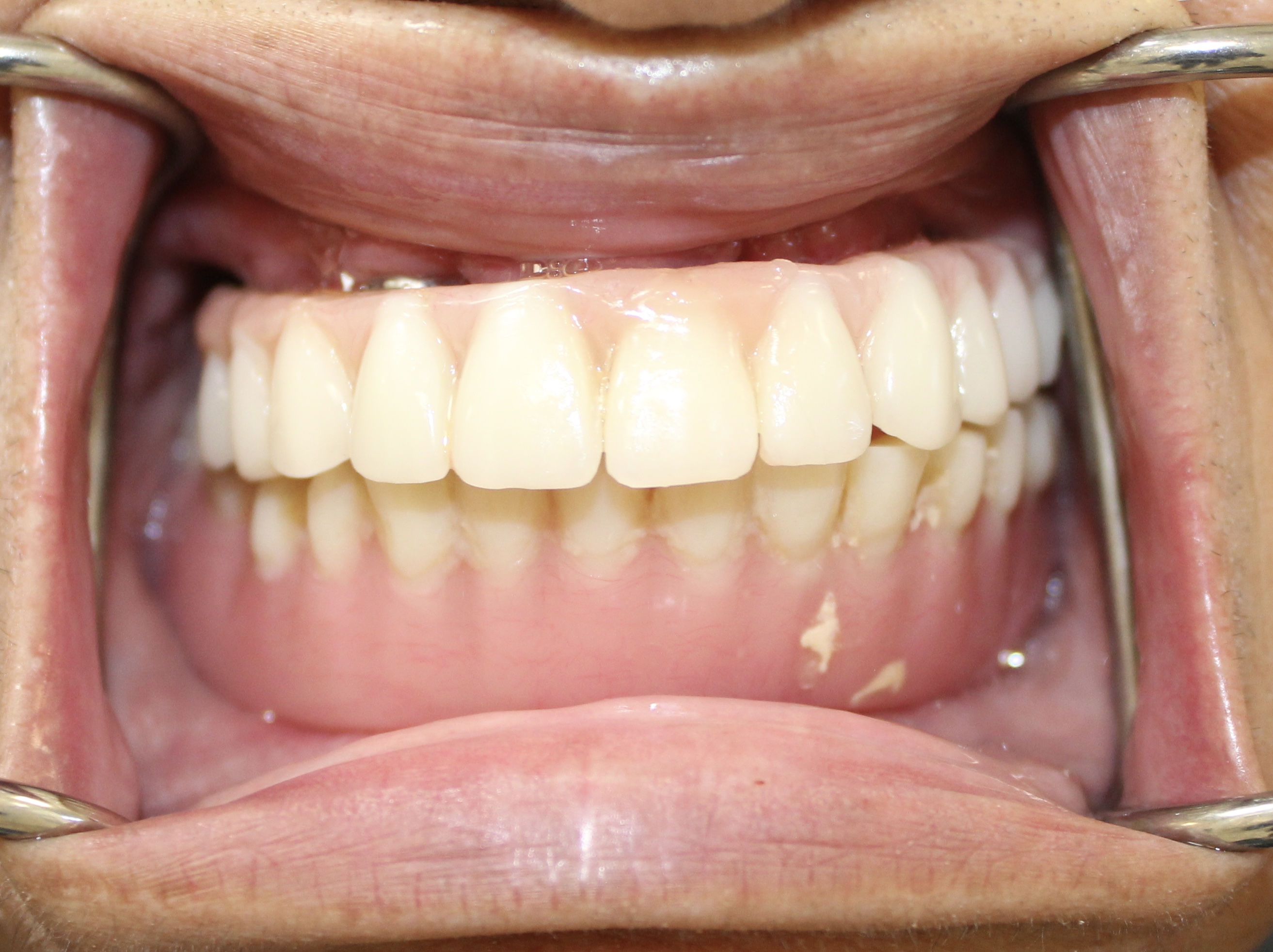 Digital workflow full-arch — Megatec Dental Lab restoration photograph 1