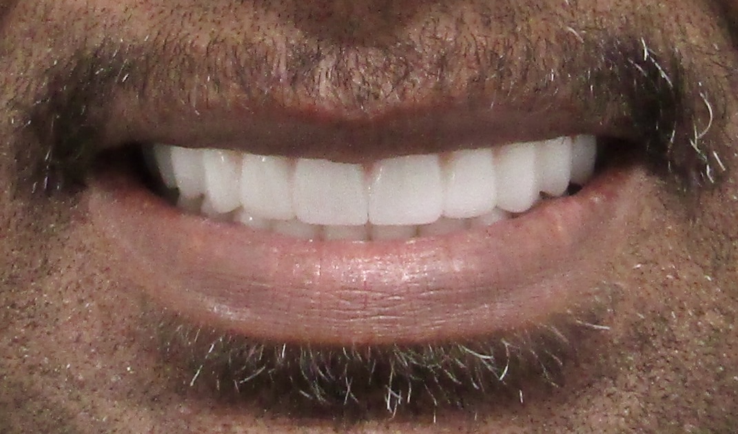 Mandibular All-on-X — Megatec Dental Lab restoration photograph 2