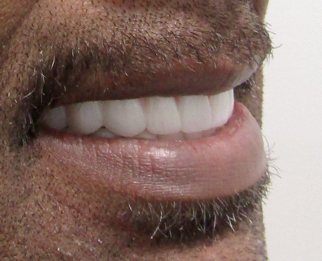 Mandibular All-on-X — Megatec Dental Lab restoration photograph 3