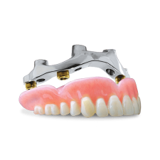 Screw-Retained Hybrid Denture