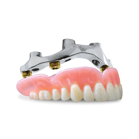 Screw-Retained Hybrid Denture