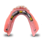 Overdentures for Implant Cases