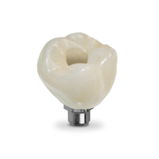 Screw-Retained Crown